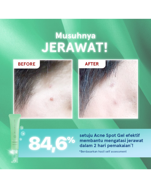 ACNE CARE SPOT GEL