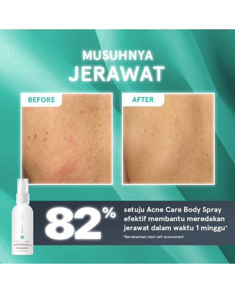 ACNE CARE BODY SPRAY